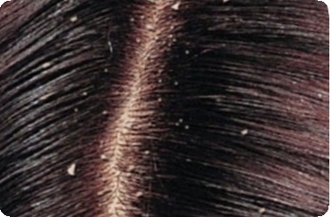 Маски для волос против перхоти